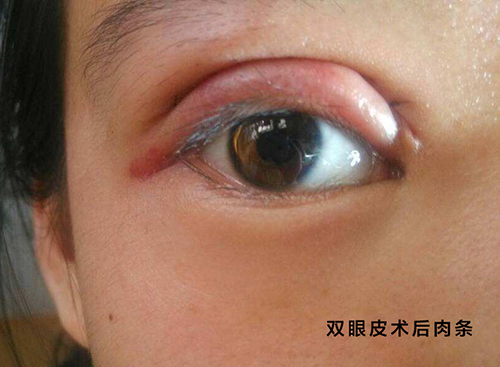 双眼皮术后肉条.jpg