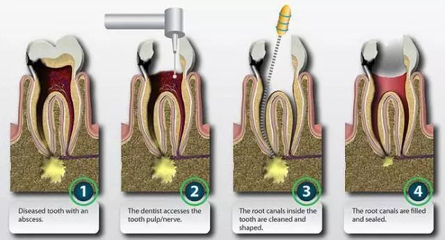 牙髓失活术图片
