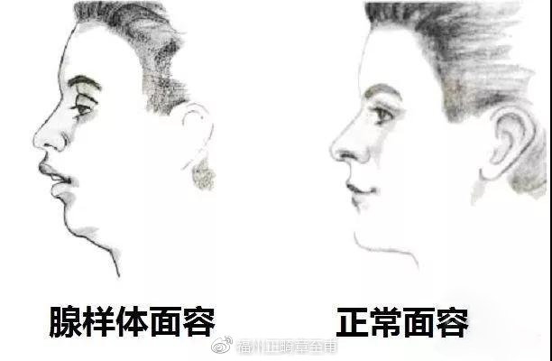 为什么会有口呼吸?