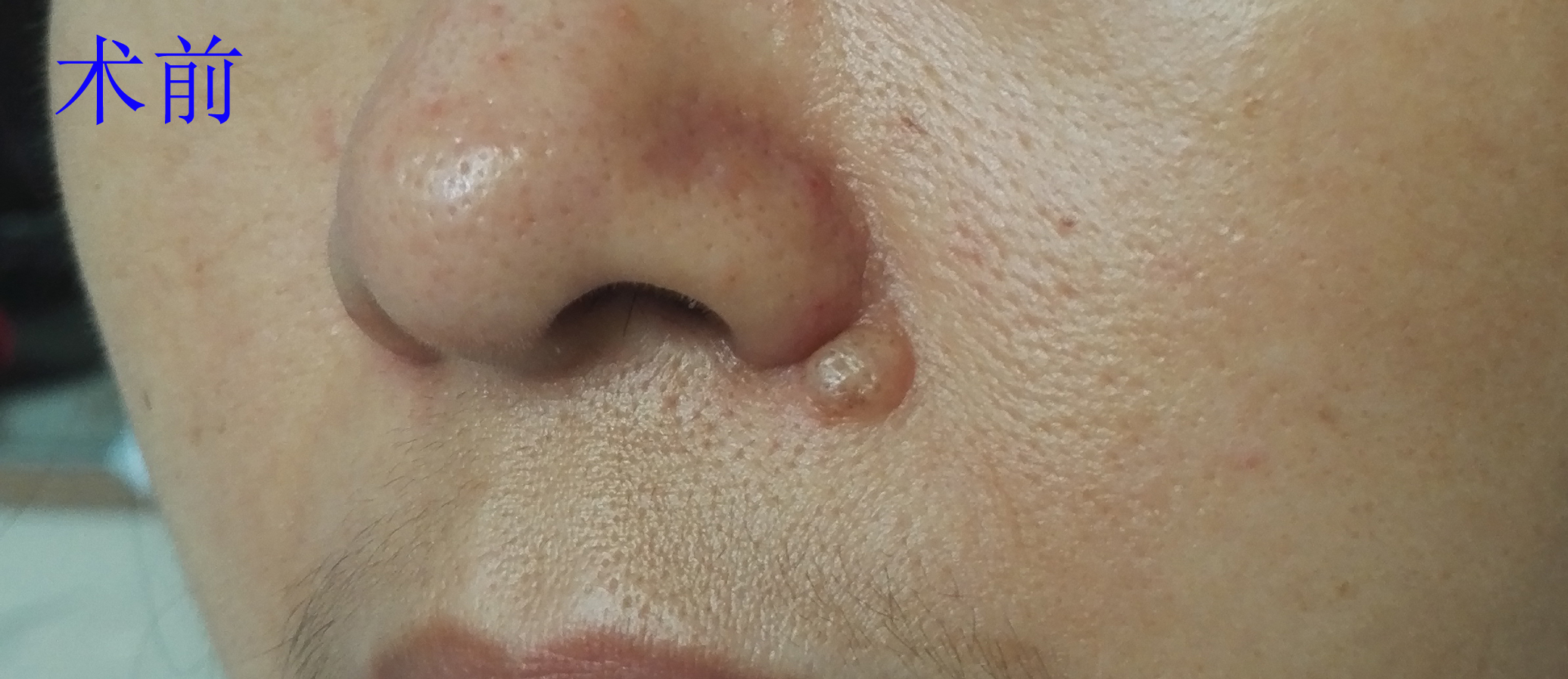 风筝皮瓣修复鼻翼沟黑痣