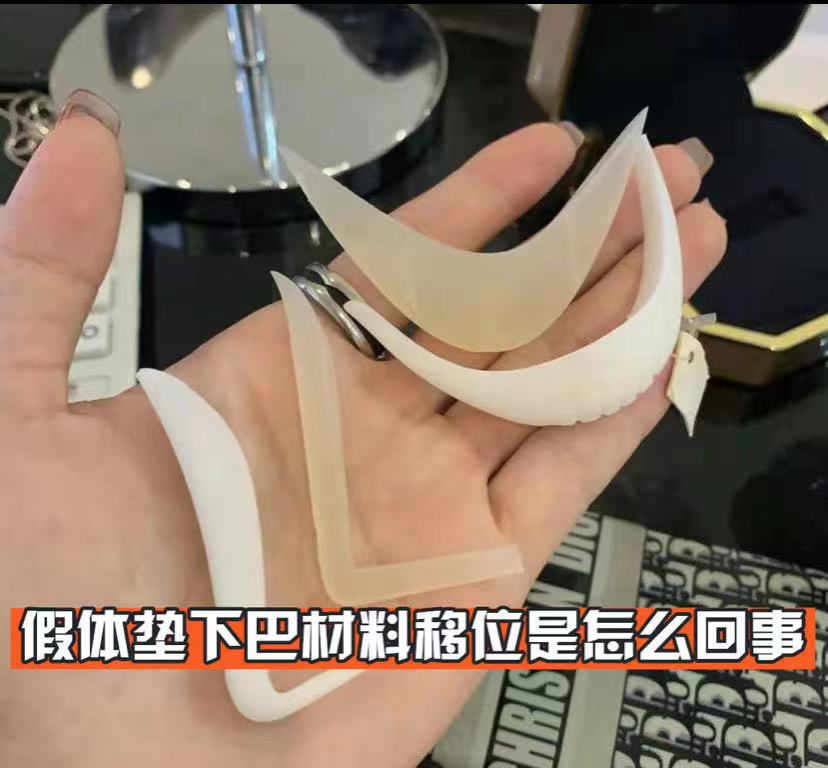 假体垫下巴材料移位是怎么回事?