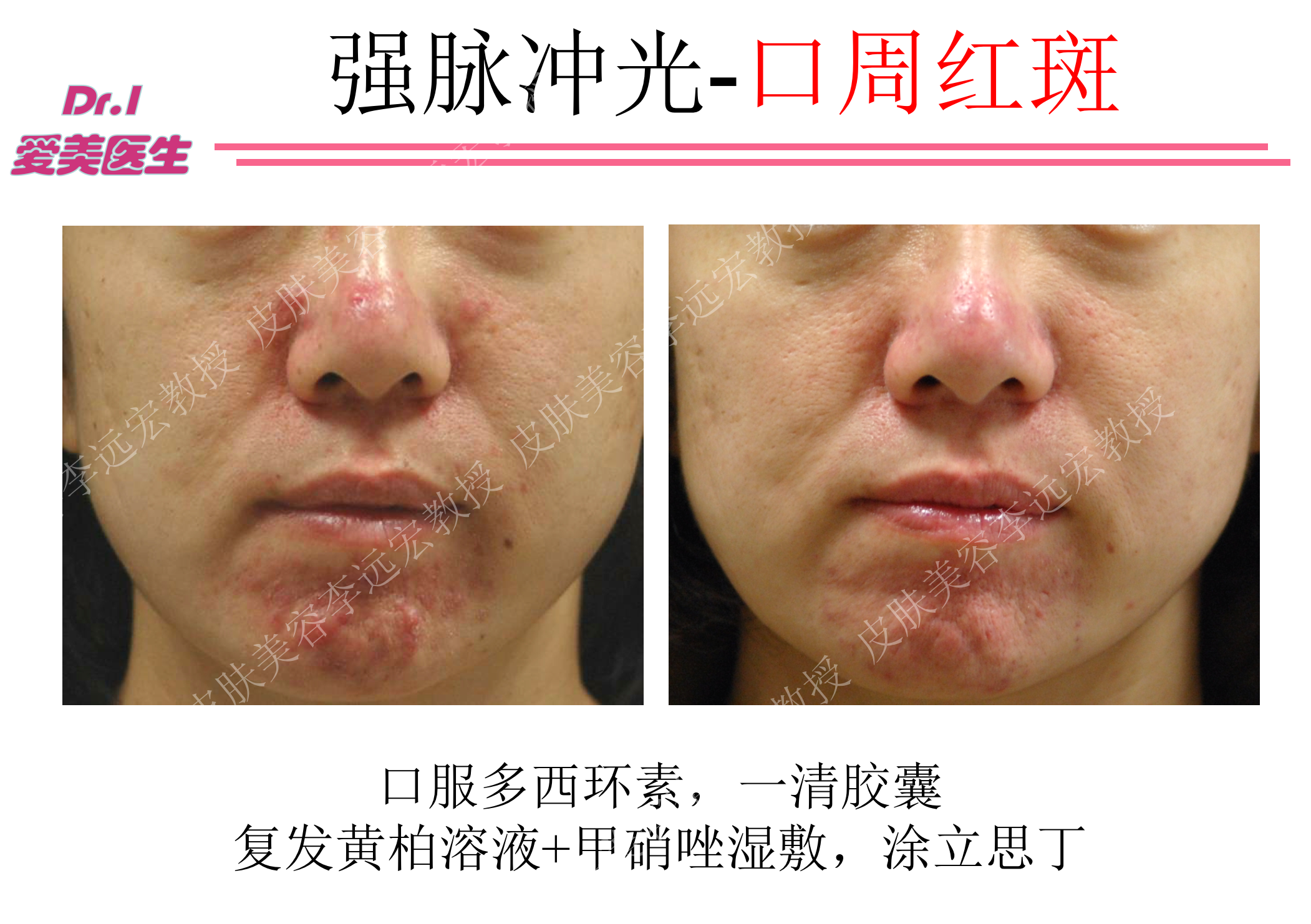 酒渣鼻/红斑痤疮的综合治疗