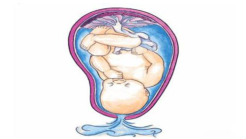 什么是胎膜早破孕妇发生胎膜早破怎么办