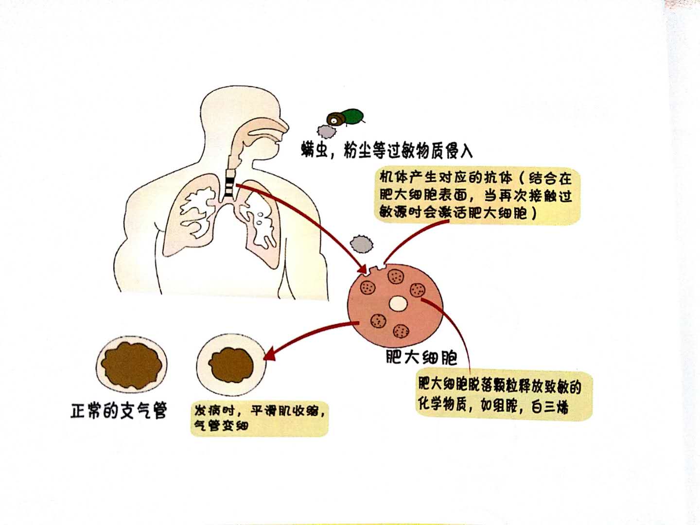 神經信號轉導機制和氣道重購及其相互作用等,過敏性哮喘大致發病機制