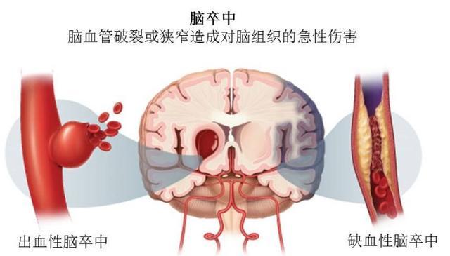 都叫腦中風是一個病嗎?