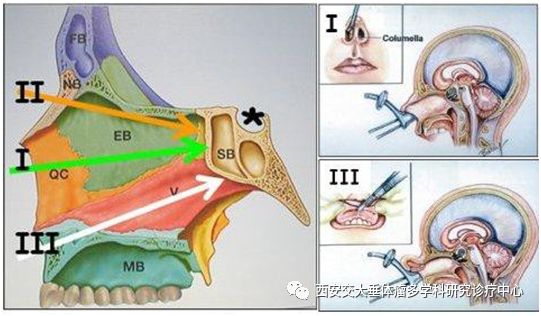 圖例:經蝶入路手術方式:i 經鼻入路(現在最常用的方式),ii 經篩骨入路