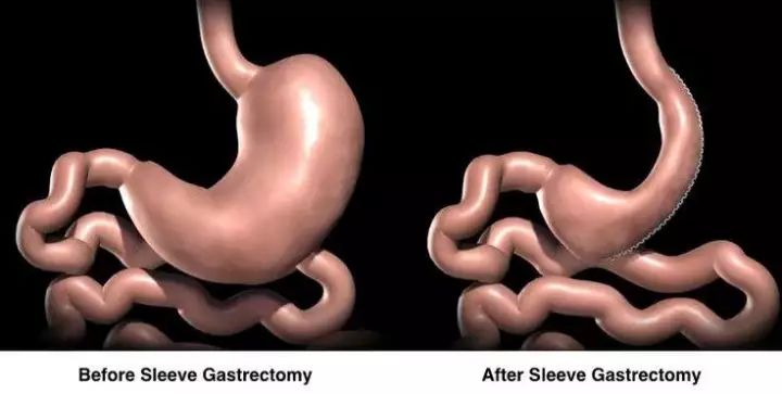 袖状胃切除术的风险