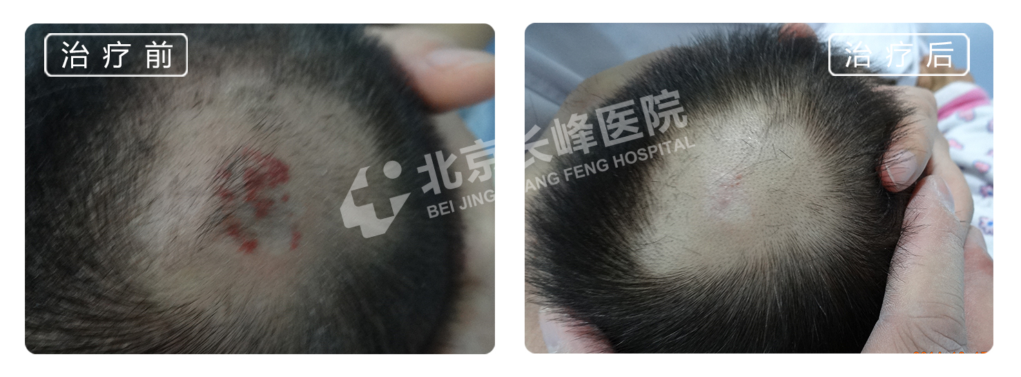 科普| 治疗血管瘤常用药物心得安(盐酸普萘洛尔)解读