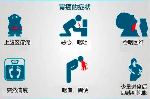 胃癌的早期症状有哪些?哪些人是高危人群?