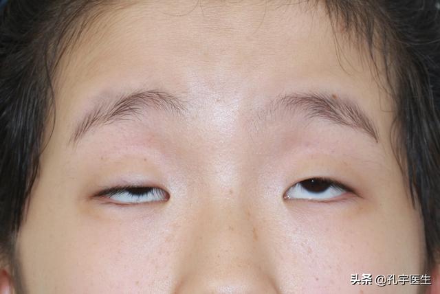 点击此处添加图片说明文字科学的治疗小眼睛问题,目前靠谱的还是手术