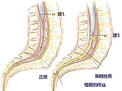 新生儿脊髓栓系图片