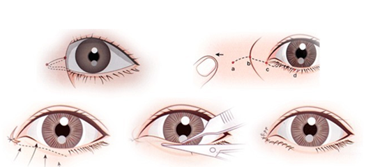 想做双眼皮?这些眼部术式你了解吗?