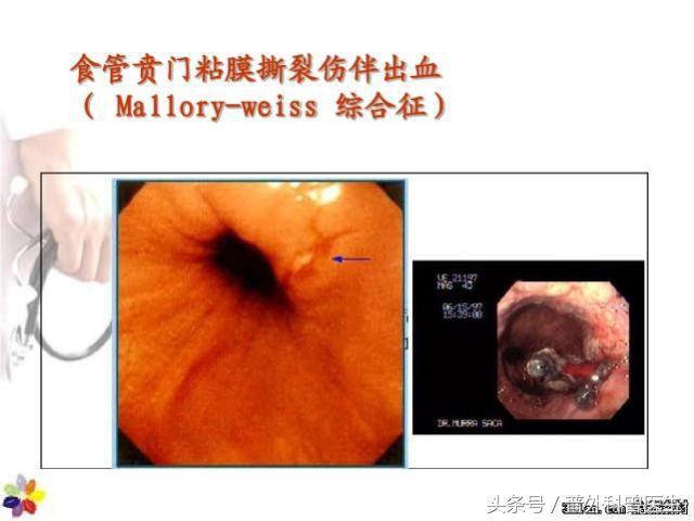 老年慢性支气管炎的症状_慢性炎症状气管支老年病变_老年性慢性支气管炎