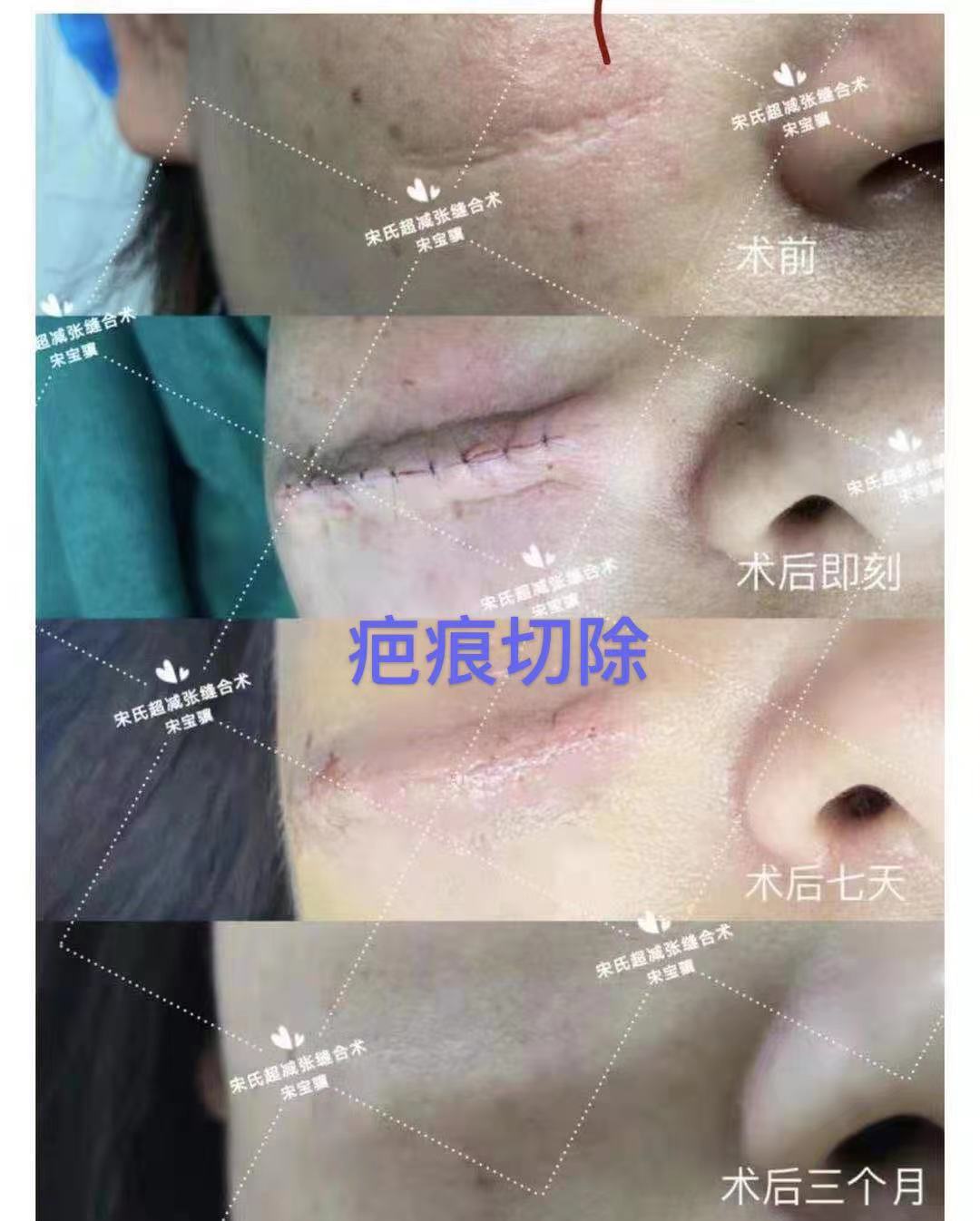 脸上的疤痕如何祛除_凤凰网视频_凤凰网