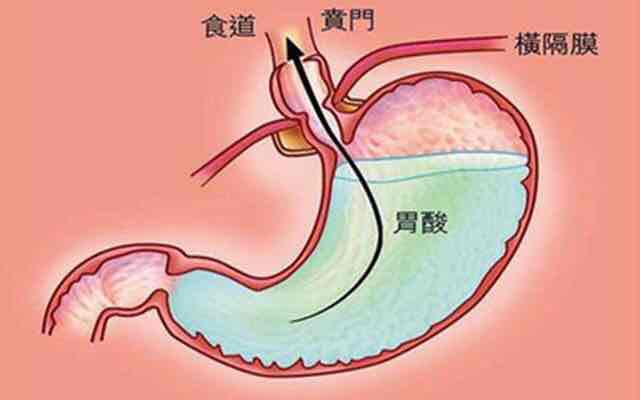 什么是反流性食管炎?该如何预防?