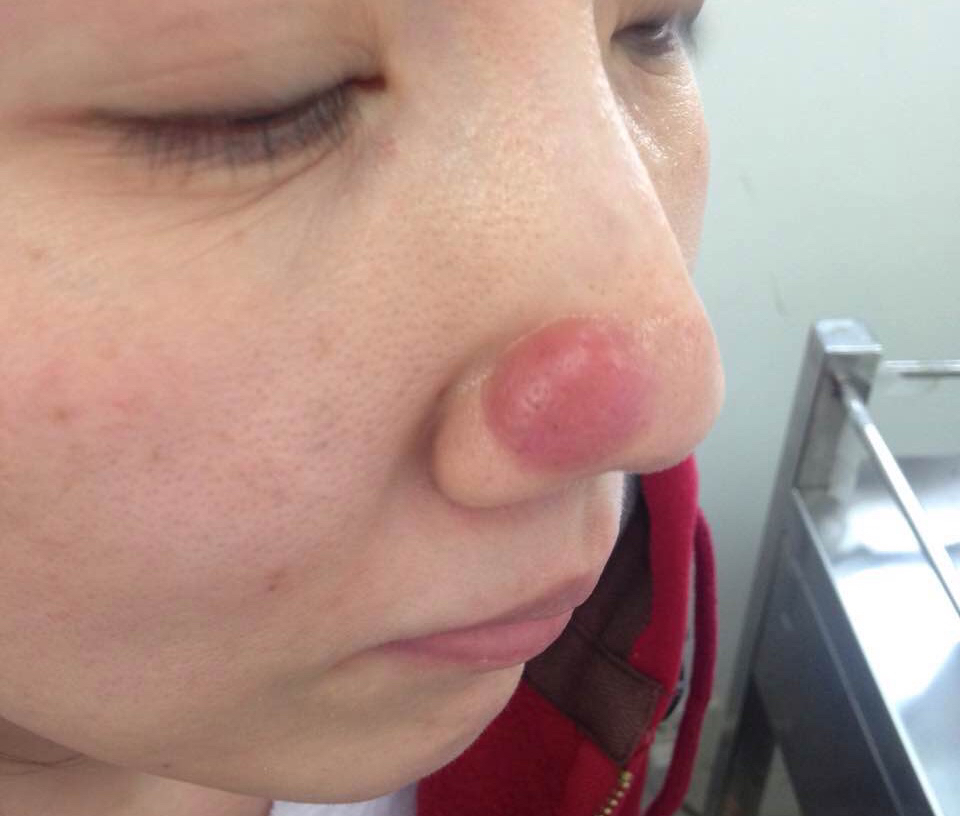鼻子上长了个少见的大红包既不是青春痘也不是毛囊炎是啥呢