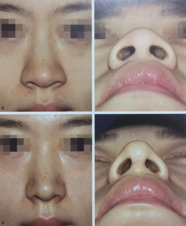 《亚洲人鼻整形术》)以上两个案例都是整形外科专著上有关鼻翼缩小的