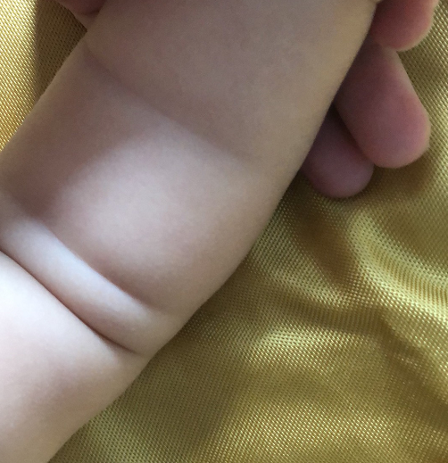 宝宝束带和肥胖要注意区分,束带在什么情况下需要手术干预?