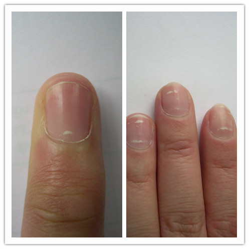 指甲上长小白点,和肚子里的蛔虫并没有必然的联系,也就是说指甲上长了