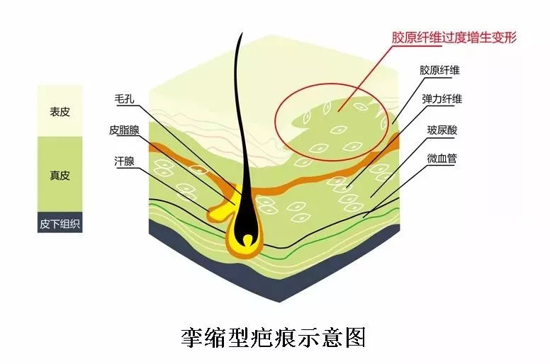 後比較容易出現輕度的頸部活動受限感,嚴重的患者會有