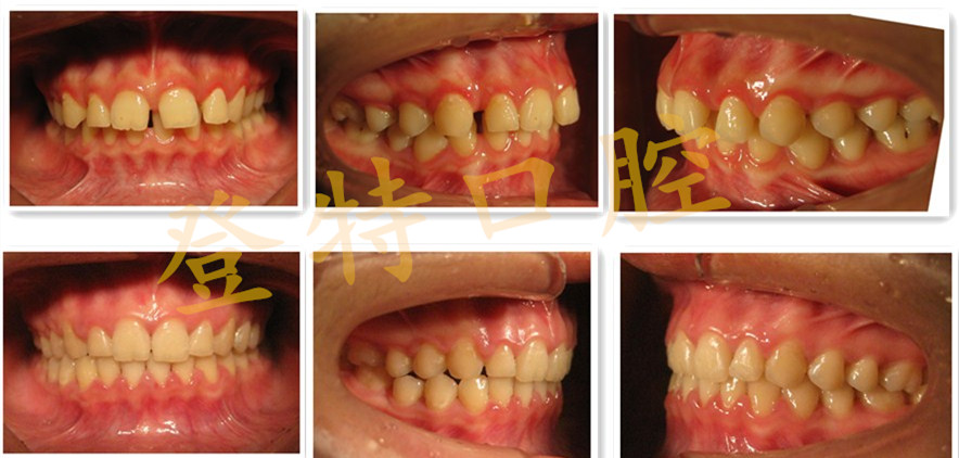 齒間縫隙牙弓與牙齒大小無法配合,當牙齒太小牙弓太大時,會造成牙齒