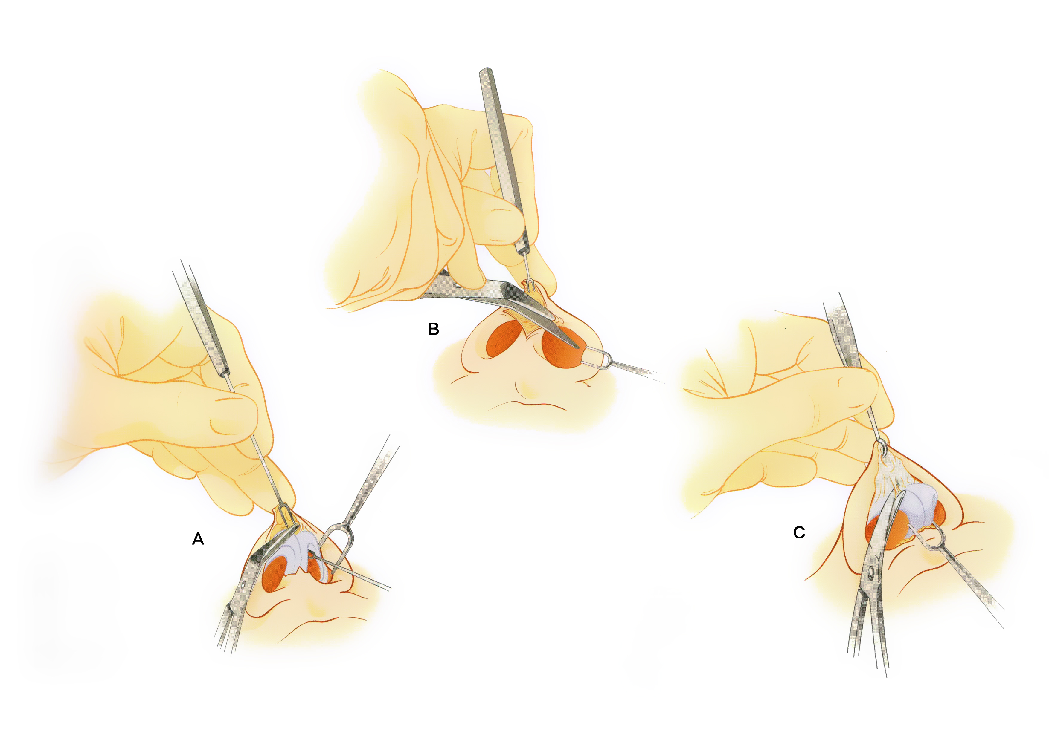 单纯假体隆鼻手术过程大揭秘