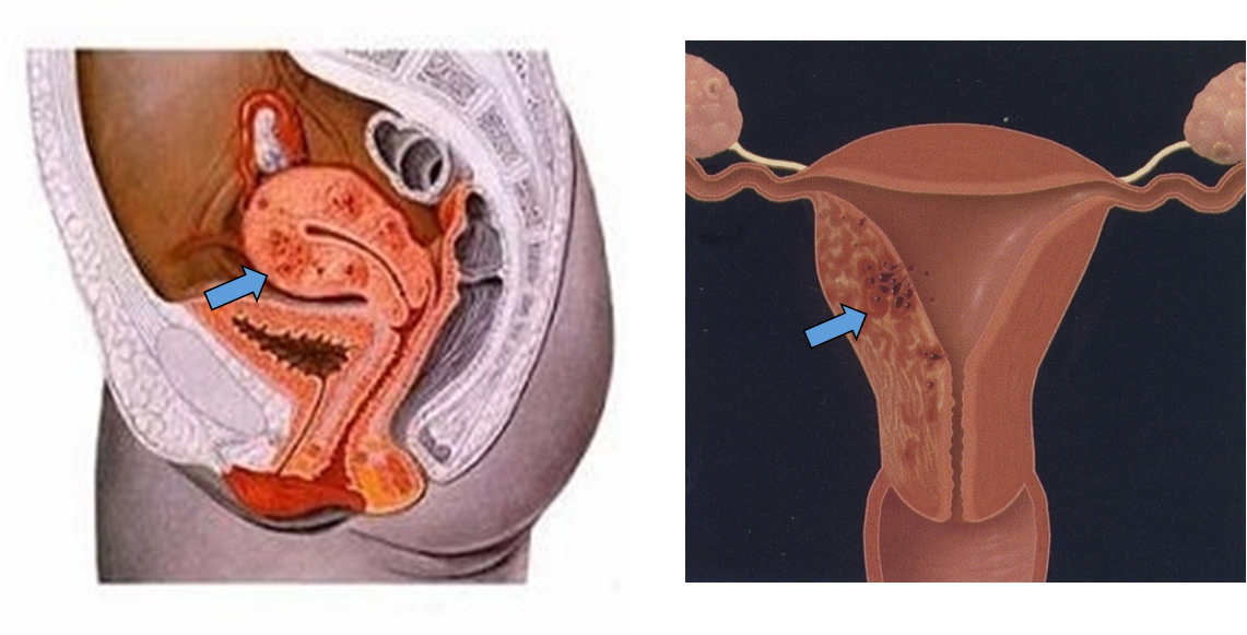 子宫腺肌病(adenomyosis):子宫肌层内存在子宫内膜腺体和间质