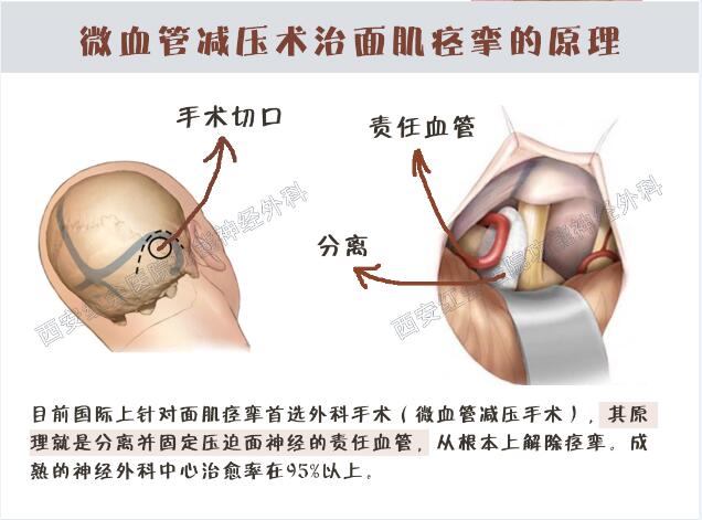 面肌痉挛显微血管减压手术指征