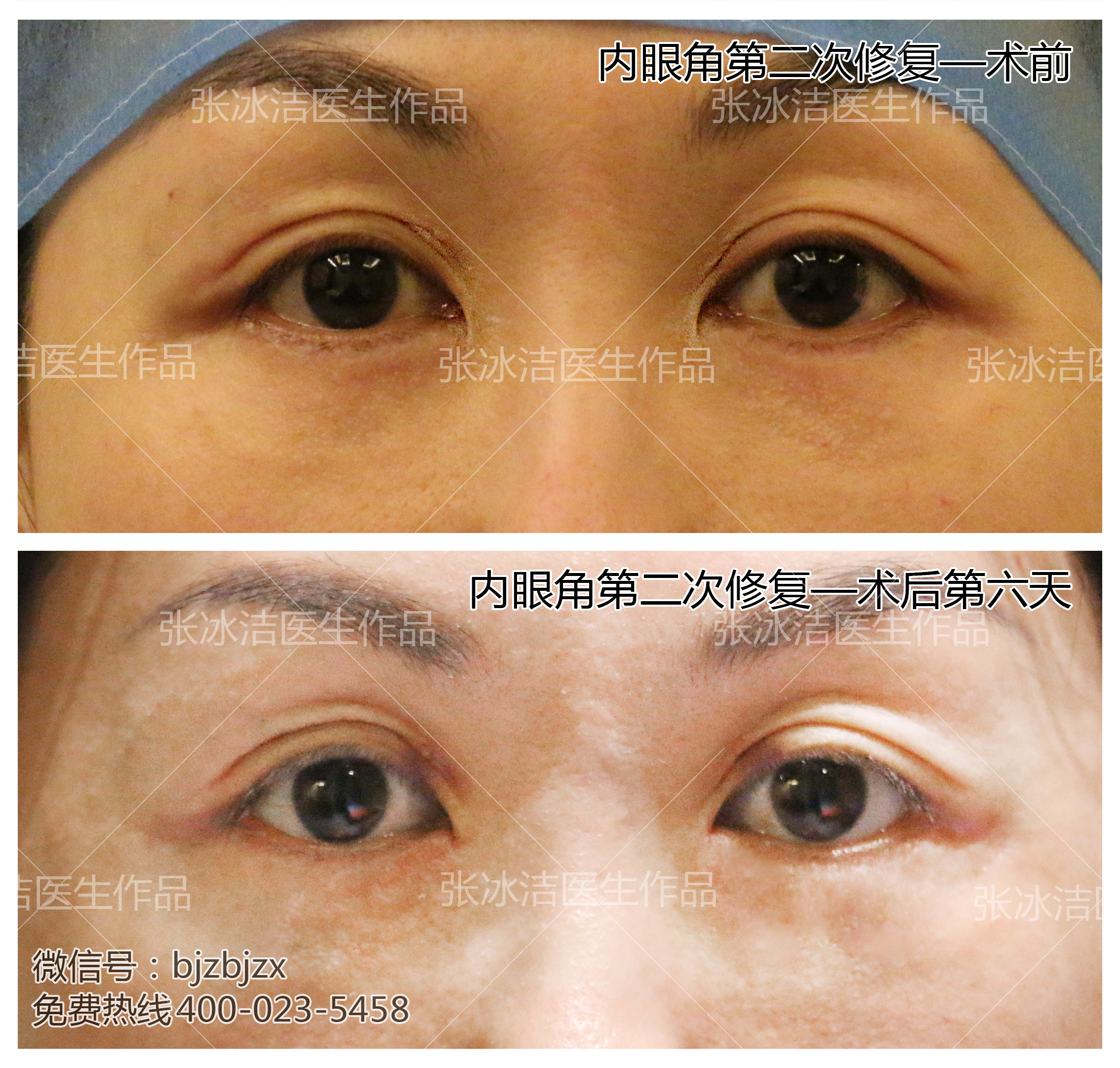 内眼角修复 | 内眼角疤痕修复部分案例-张冰杰主治医师-爱问医生