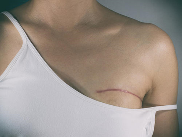 乳腺癌术后胸壁结节怎么办那就是恶性肿瘤吗