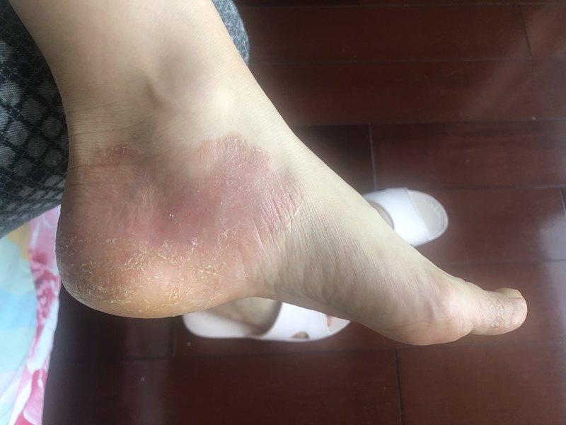 掌跖脓疱病or怀孕