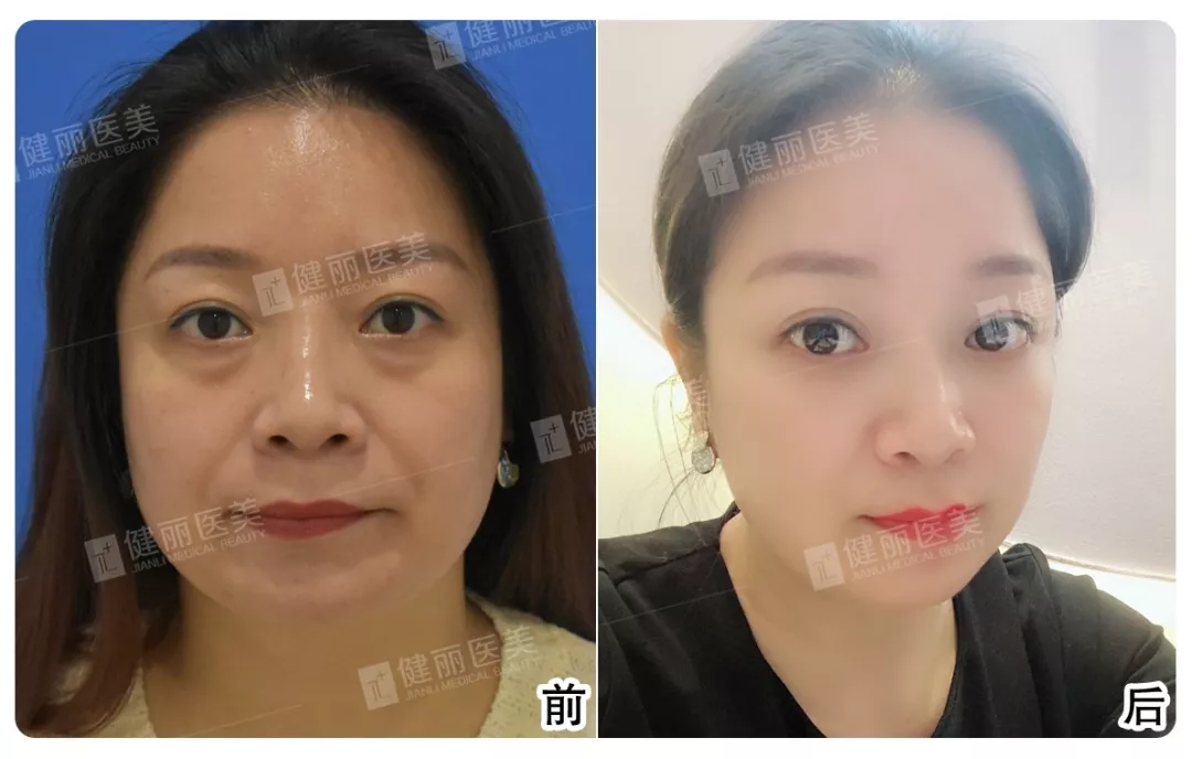 前后对比.webp.jpg