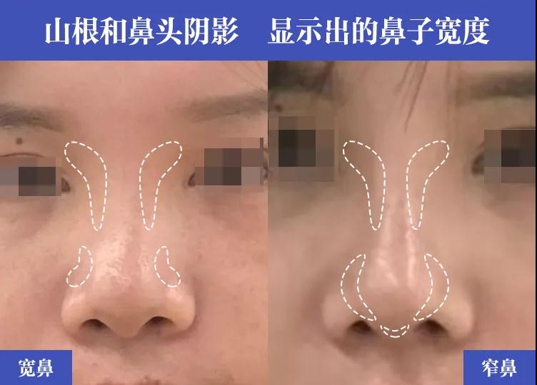 宽鼻矫正术