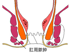 肛周膿腫常見原因