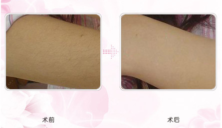 脱毛对比2.jpg
