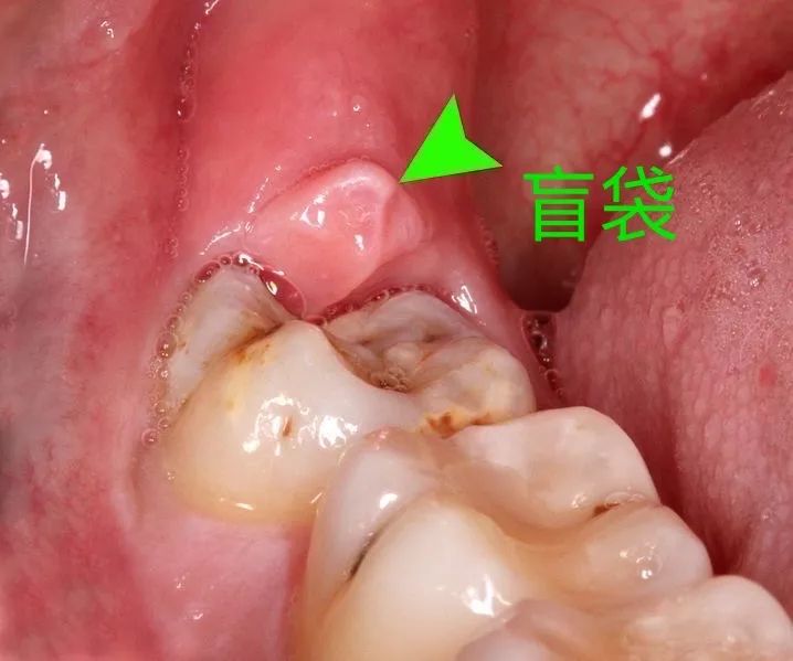 a處為智齒,b處為牙冠與牙齦形成的盲袋丨wikipedia反覆智齒冠周炎