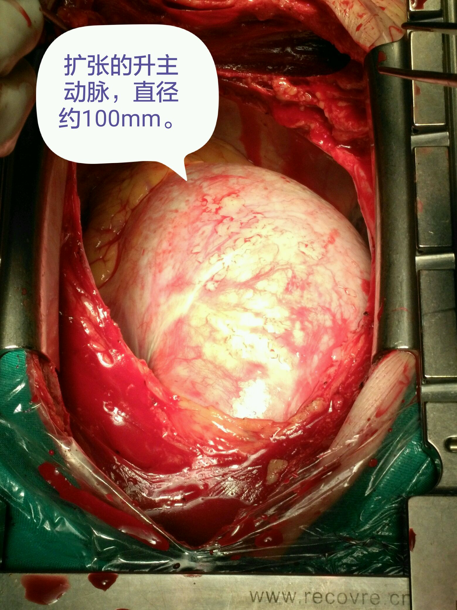 巨大升主动脉瘤1例