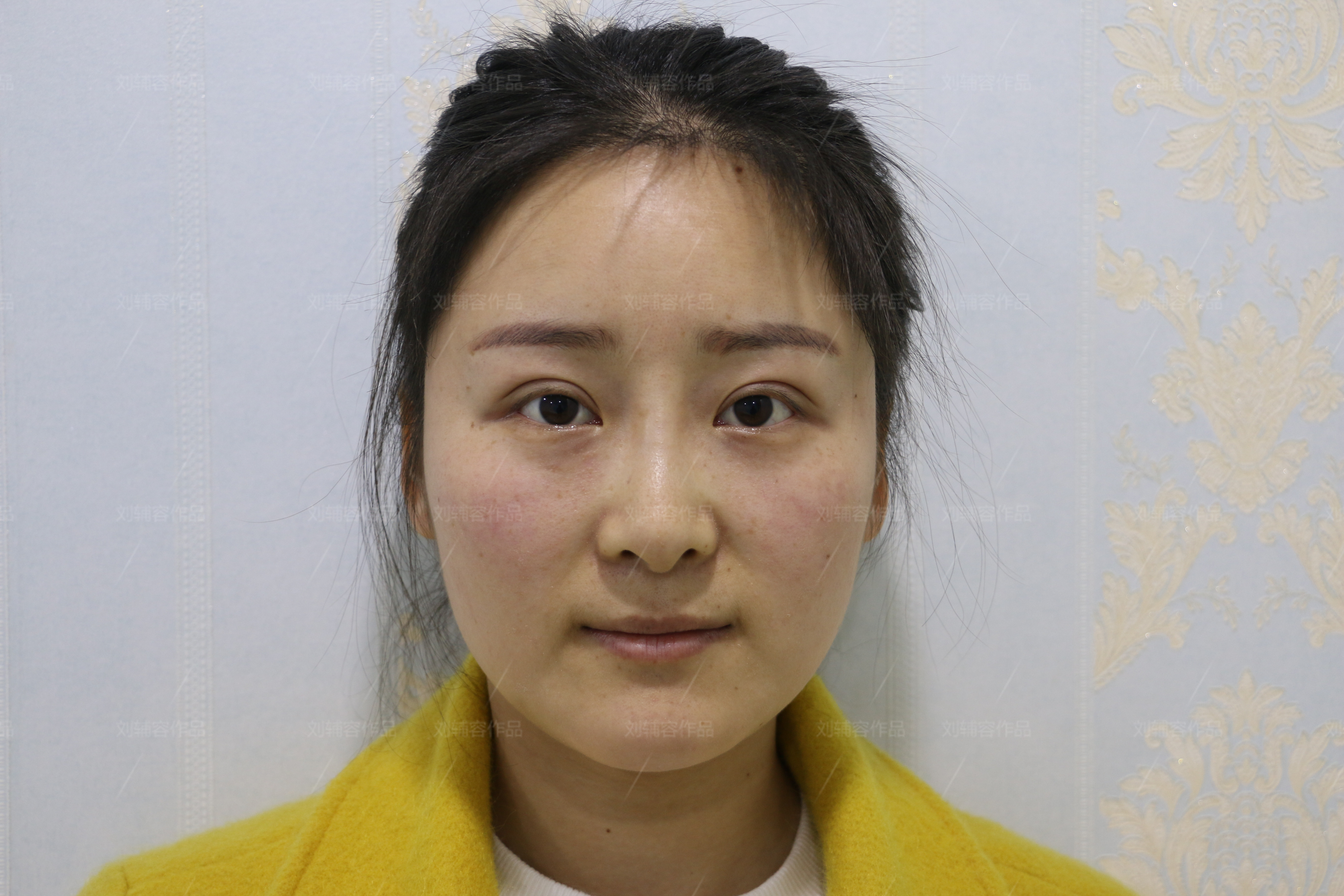 医生诊断方案说明书双眼皮修复