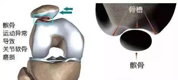 膑骨软化—膝关节疼痛不再是老年人专属并,它困扰着越来越多年轻人!