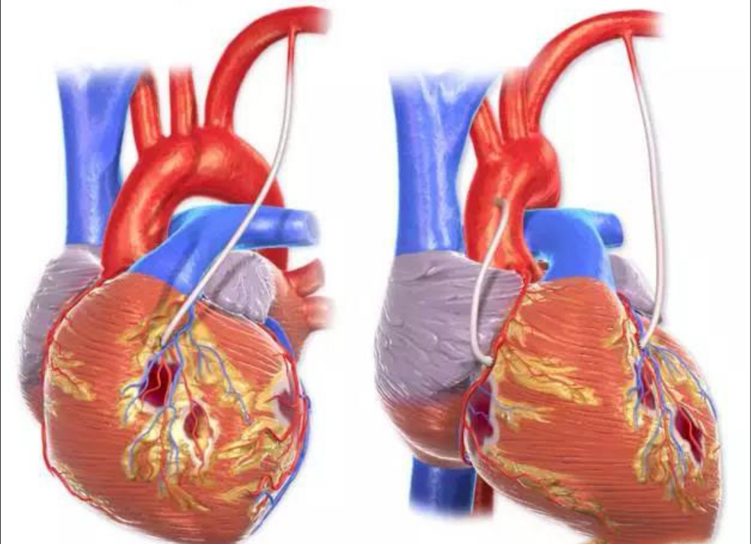心脏三支病变不做支架也不做搭桥行吗?