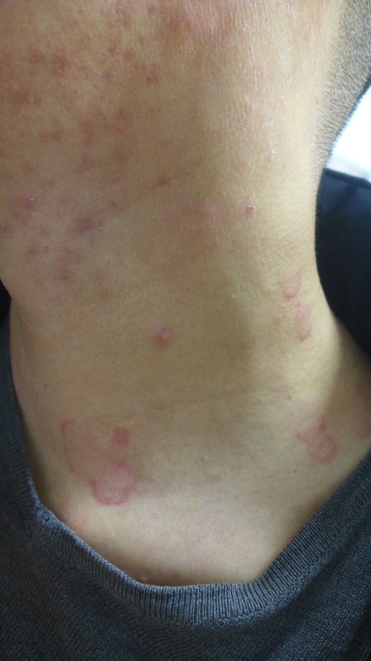 当心皮肤出现风团伴瘙痒反复发作为慢性荨麻疹