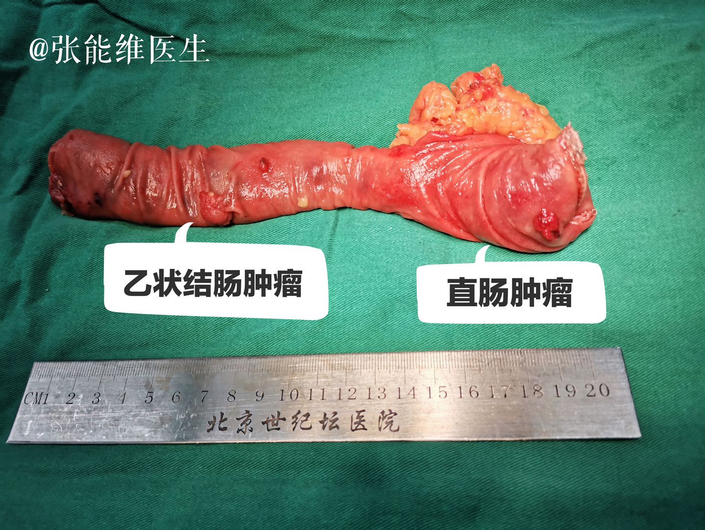 病例分享:腹腔镜下乙状结肠癌 超低位直肠癌手术