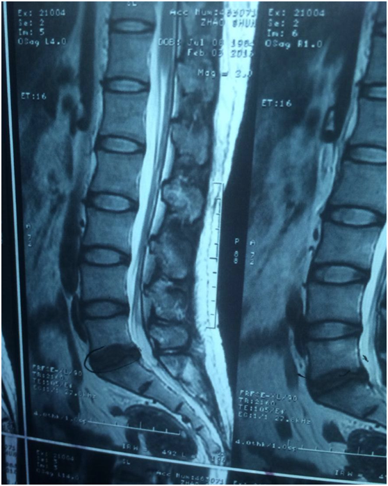 微义诊病例轻度腰椎间盘能要手术吗