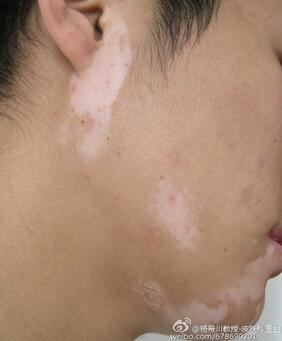 贫血痣是贫血引起的吗