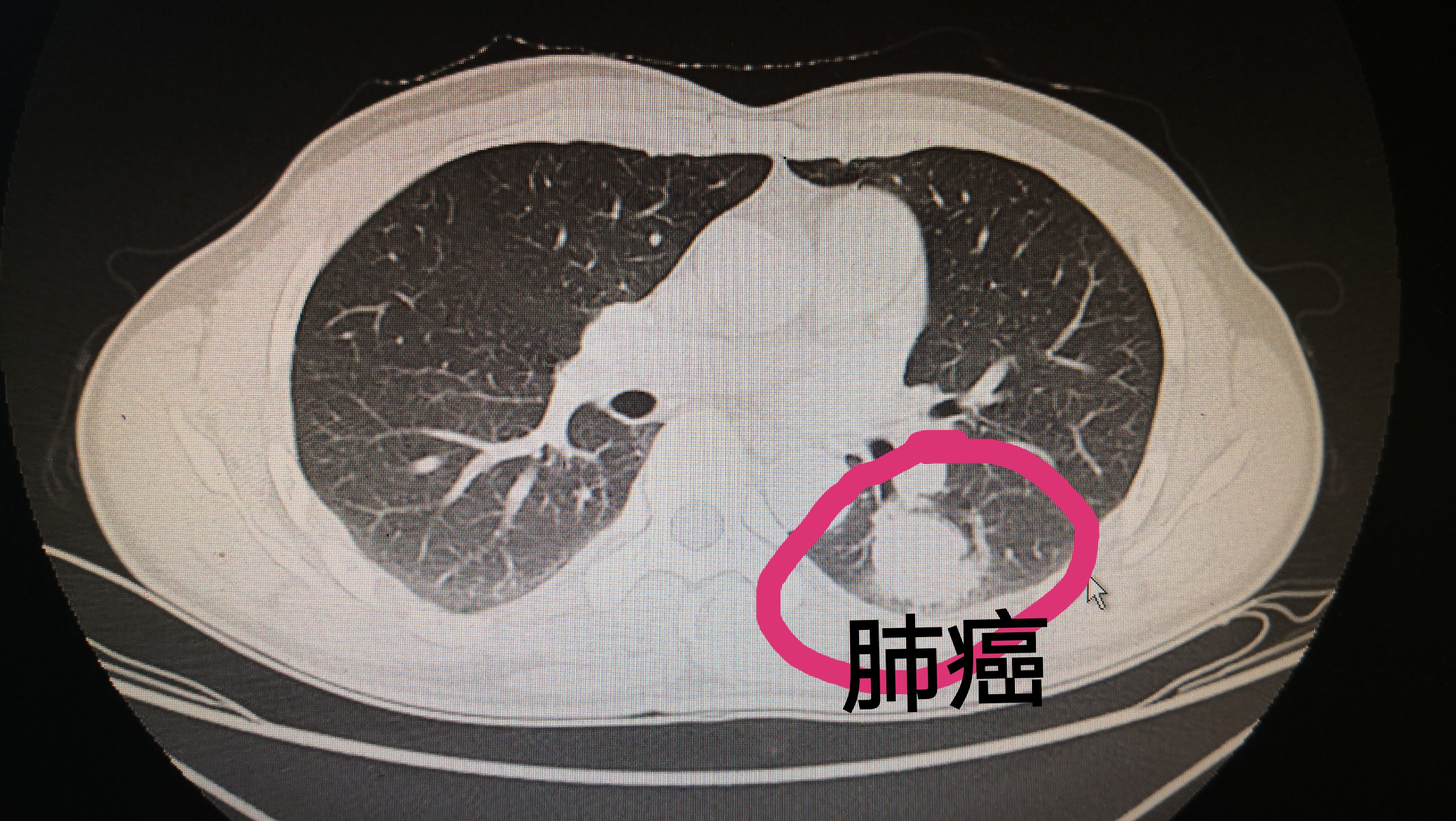 肺癌晚期症状ct图片图片
