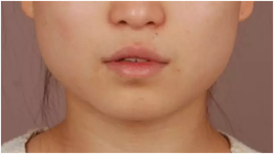 干货| 线雕提升瘦脸适合所有脸型吗?