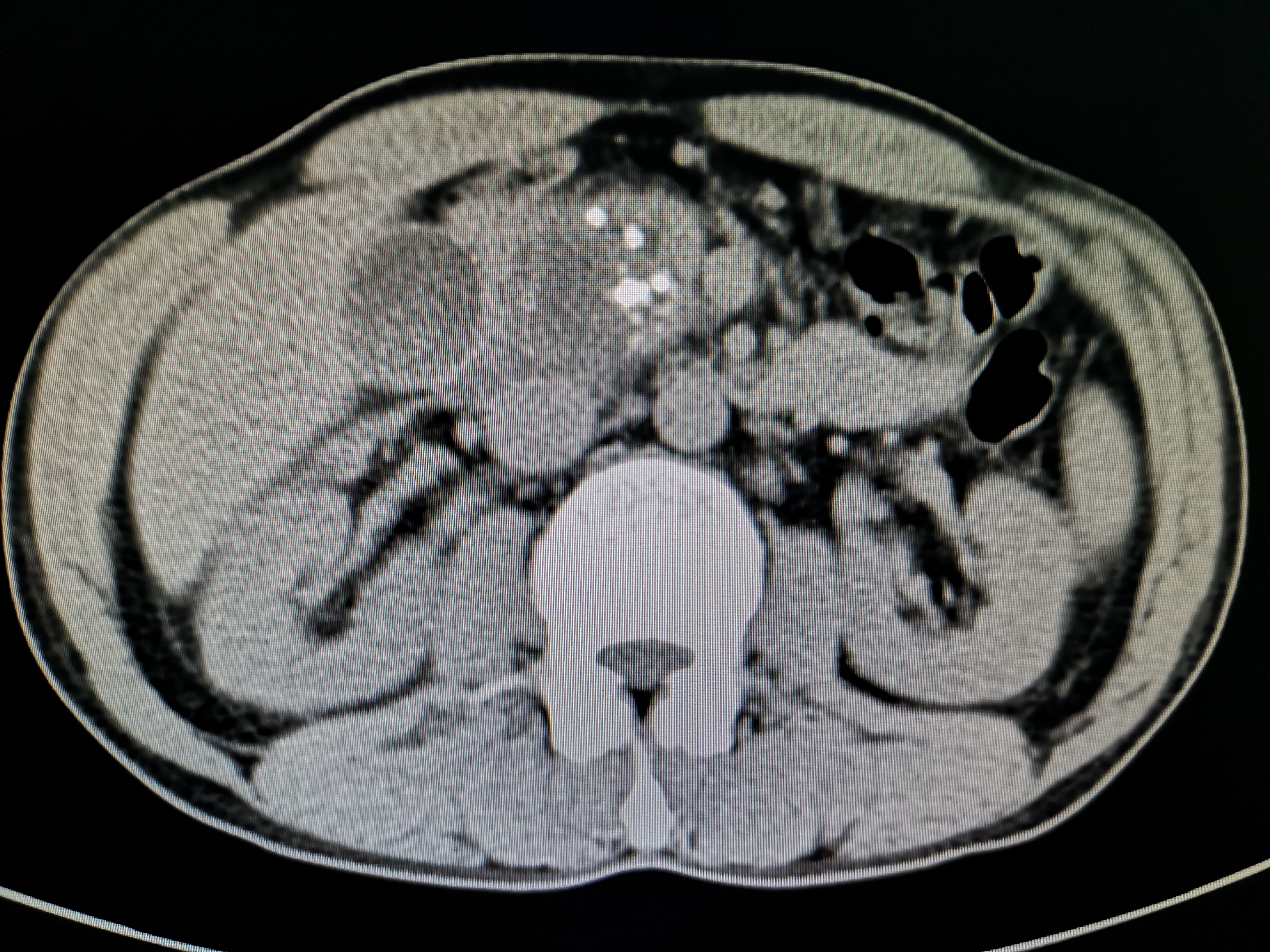胰头部囊性灶图片