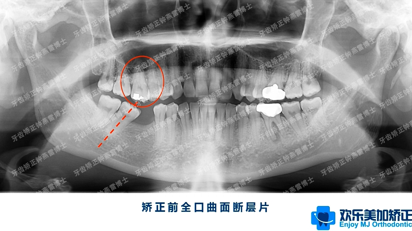 牙齿缺失久了想要种植吗?建议先找正畸医生问问吧