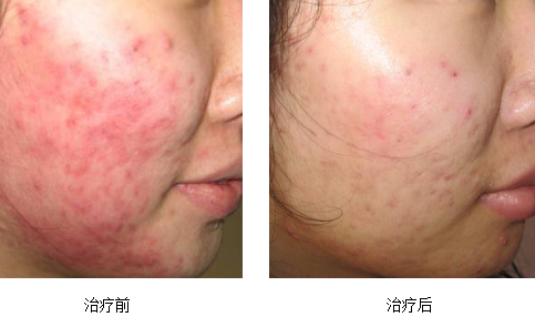 浅谈治疗痤疮(青春痘)的新手段---强脉冲光!