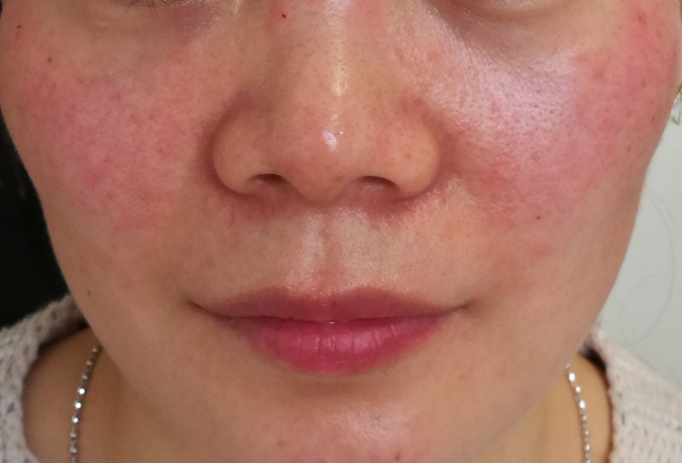 混合敏感肌:终极王者皮肤